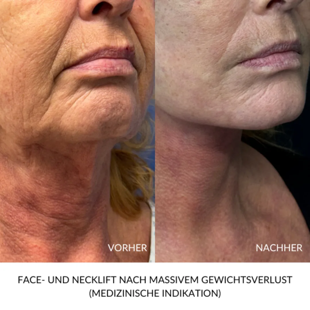 Before and after — Dr. Raya Isaev