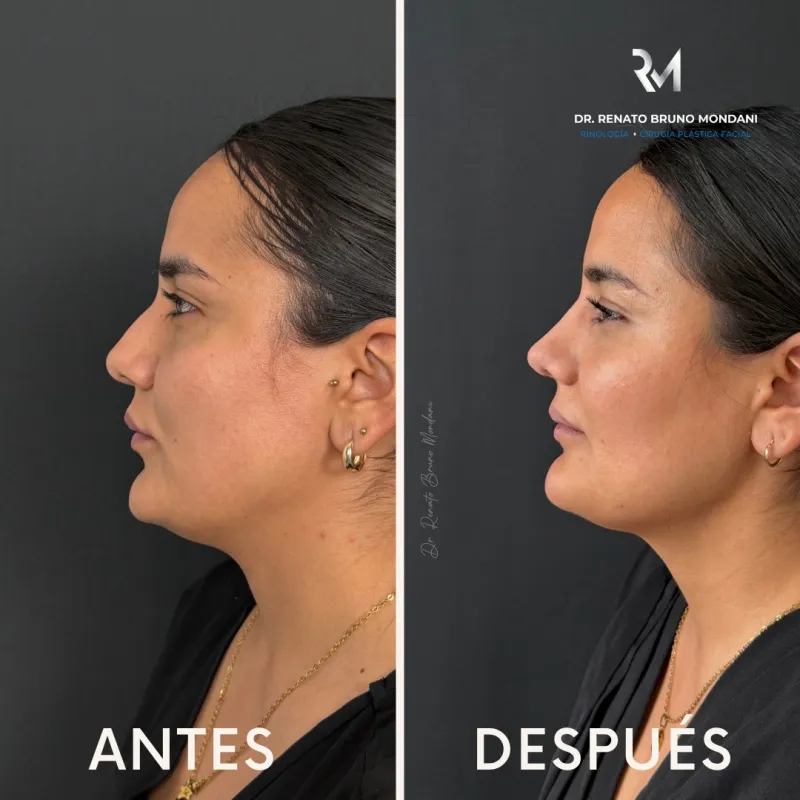 قبل وبعد - Deep Plane Facelift بواسطة د. Renato Bruno Mondani