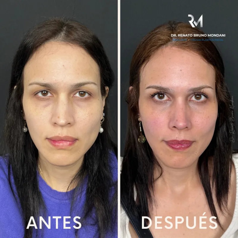 قبل وبعد - Facial Fat Transfer بواسطة د. Renato Bruno Mondani