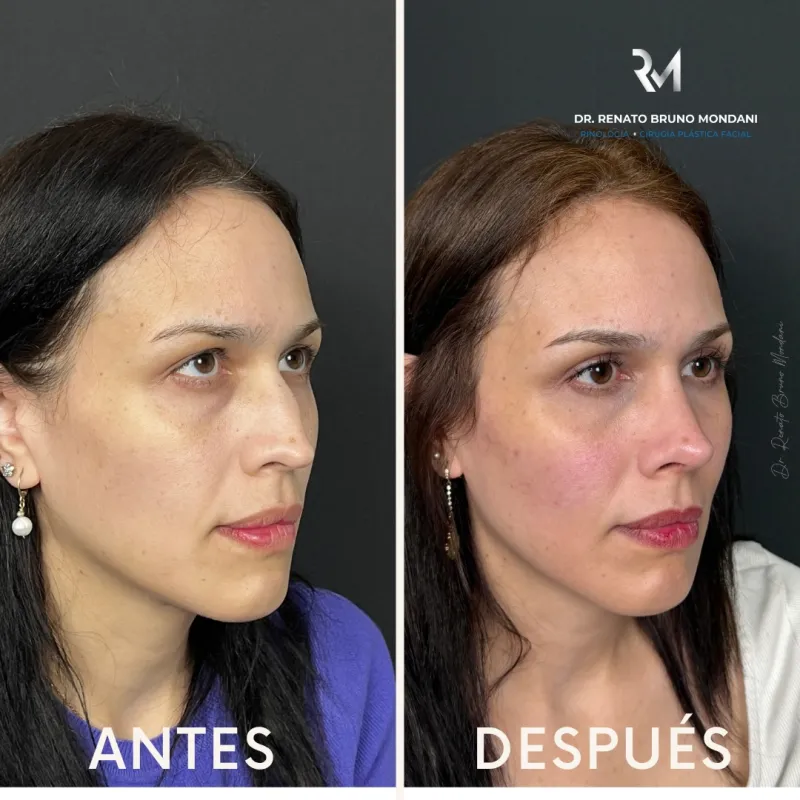 قبل وبعد - Facial Fat Transfer بواسطة د. Renato Bruno Mondani