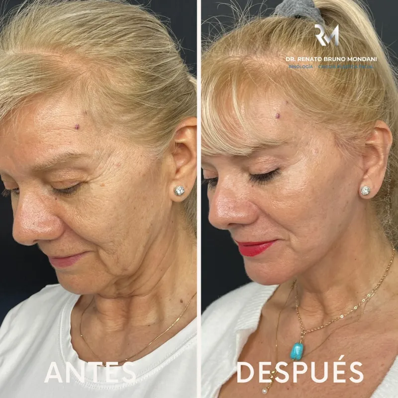قبل وبعد - Deep Plane Facelift بواسطة د. Renato Bruno Mondani