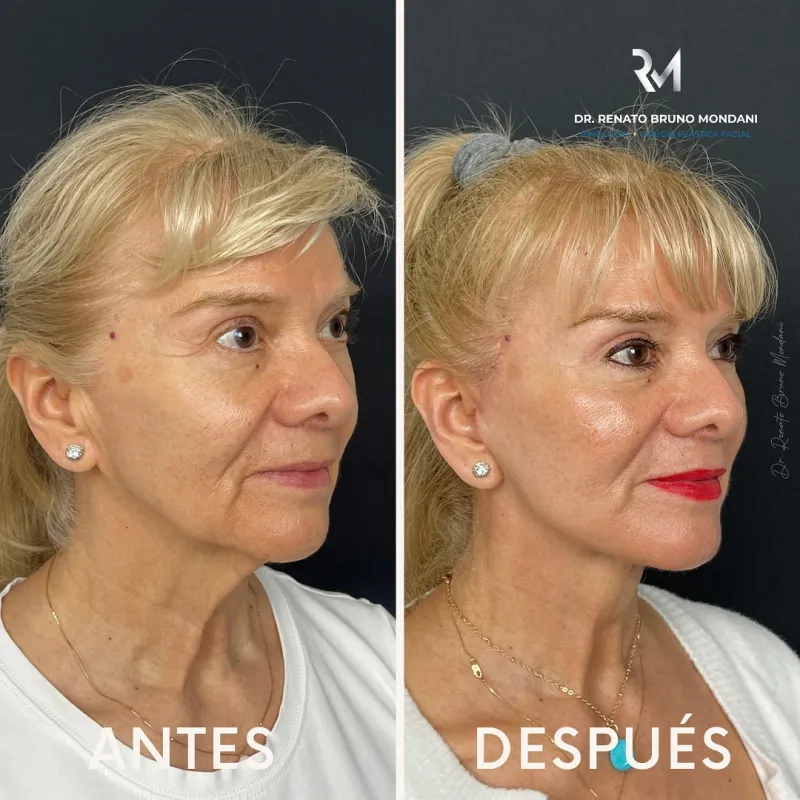 قبل وبعد - Deep Plane Facelift بواسطة د. Renato Bruno Mondani