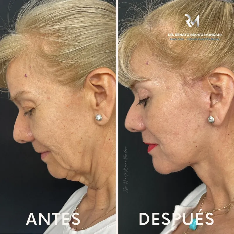 قبل وبعد - Deep Plane Facelift بواسطة د. Renato Bruno Mondani