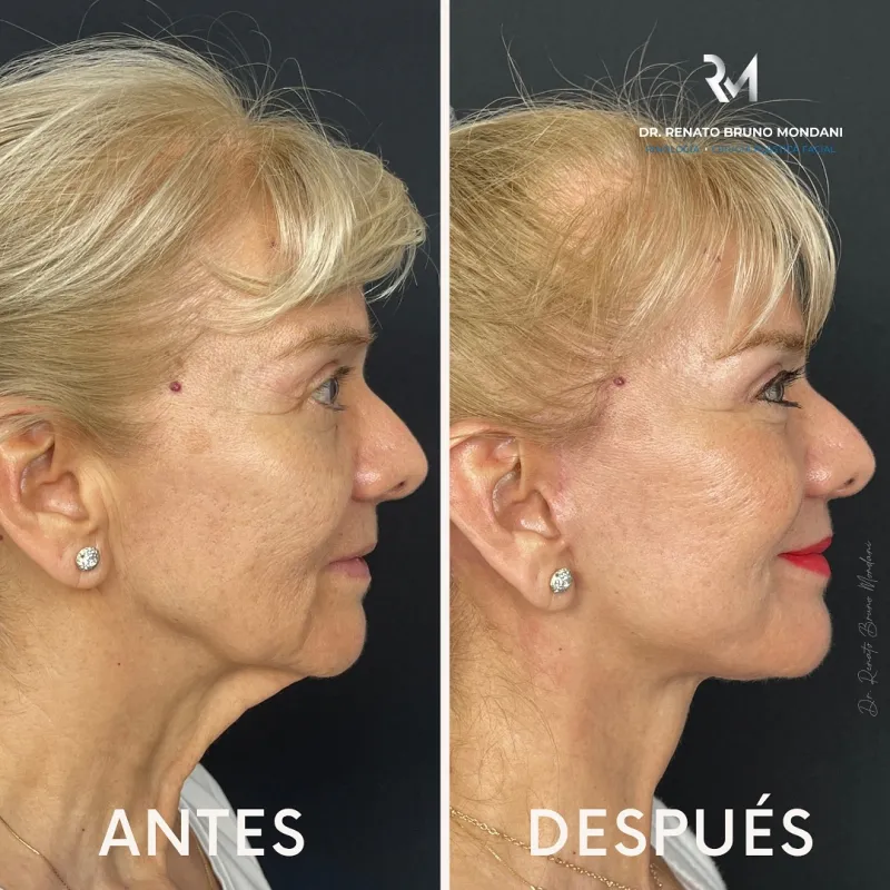 قبل وبعد - Deep Plane Facelift بواسطة د. Renato Bruno Mondani