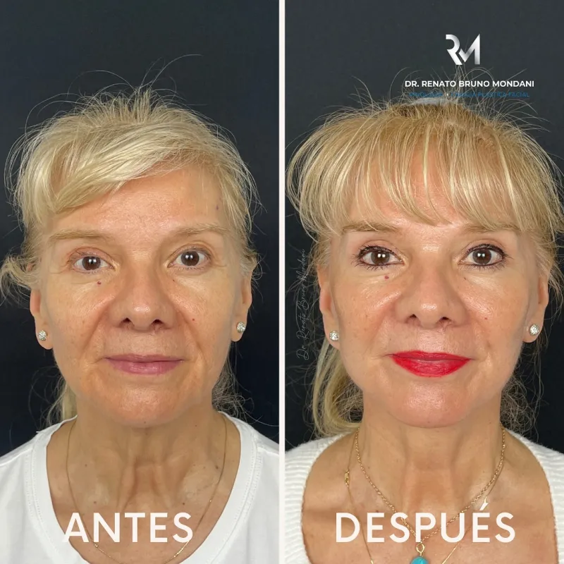 قبل وبعد - Deep Plane Facelift بواسطة د. Renato Bruno Mondani