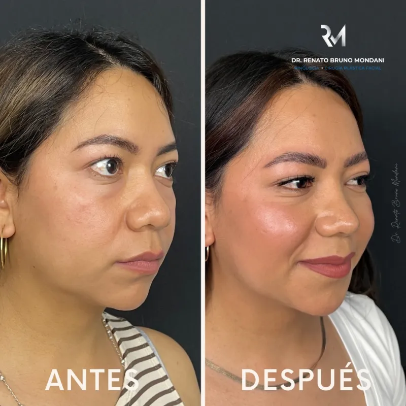 قبل وبعد - Facial Fat Transfer بواسطة د. Renato Bruno Mondani