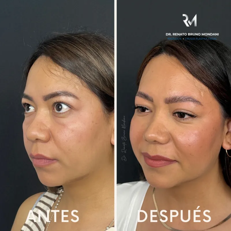 قبل وبعد - Facial Fat Transfer بواسطة د. Renato Bruno Mondani