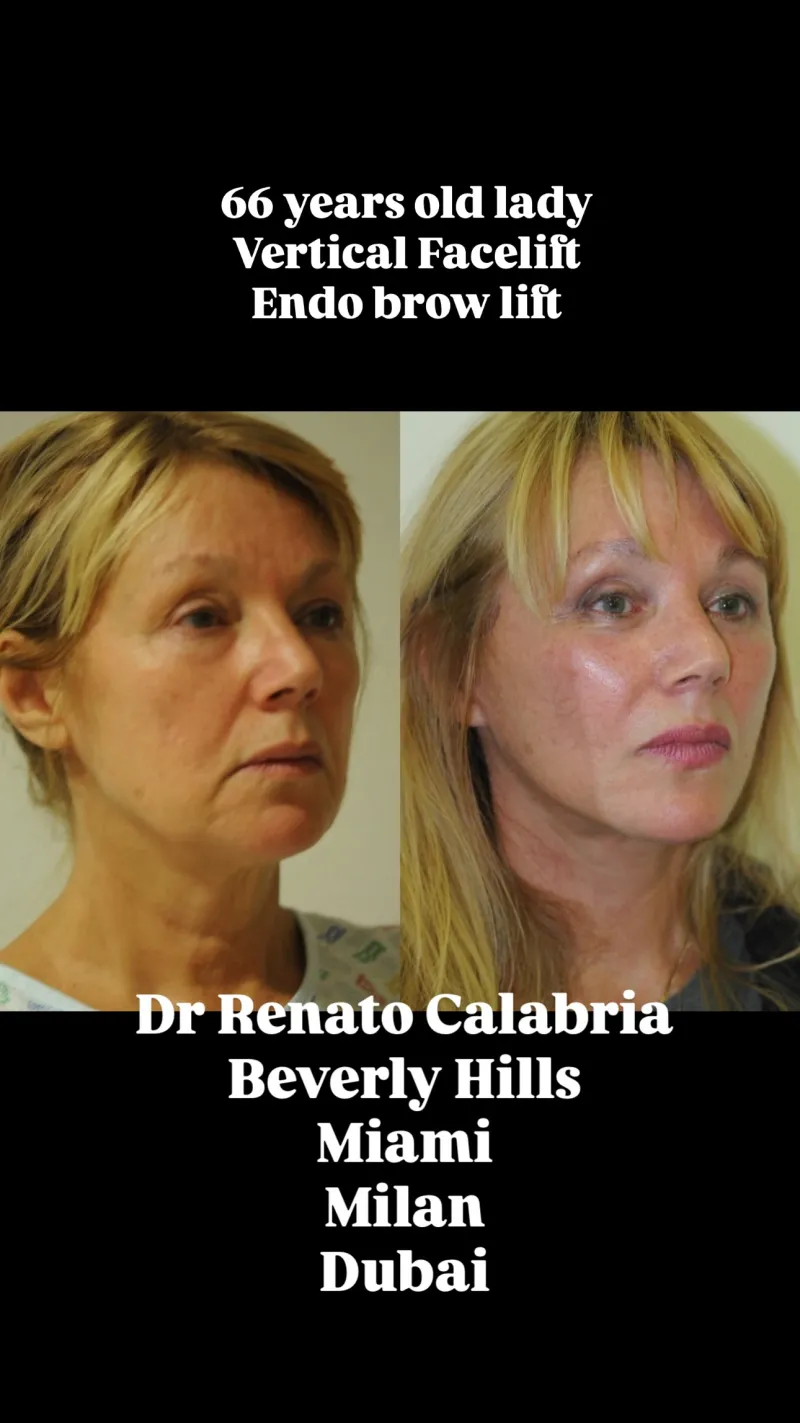 Before and after — Dr. Renato Calabria