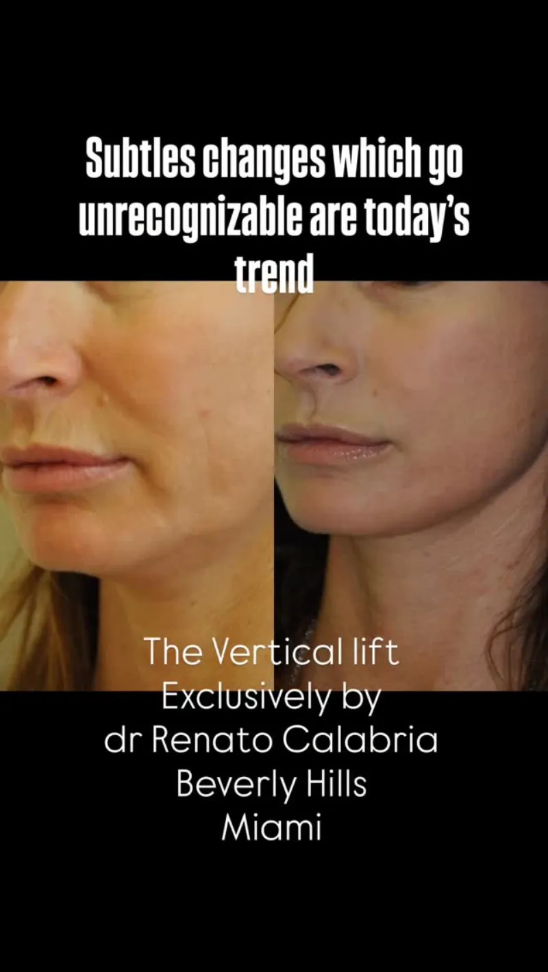 Before and after — Dr. Renato Calabria