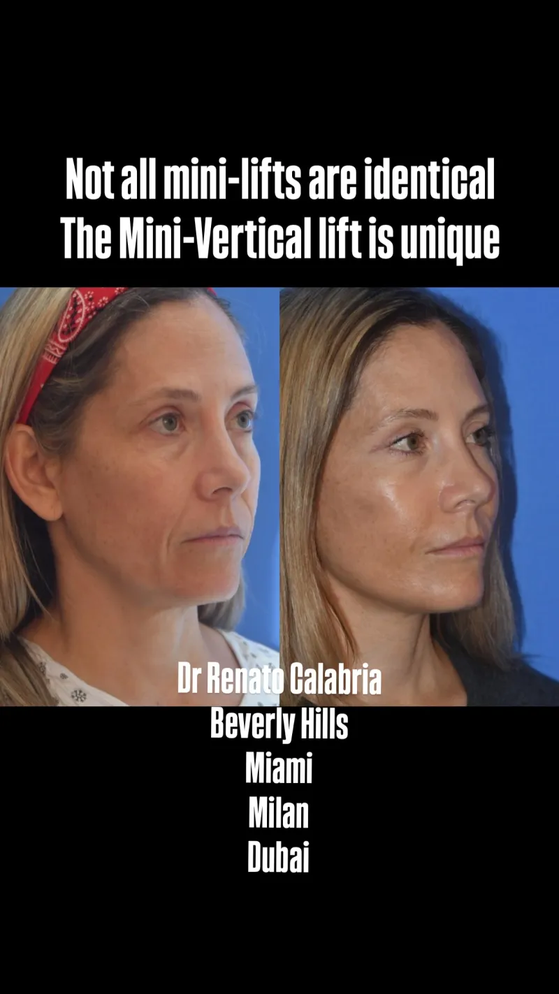 Before and after — Dr. Renato Calabria