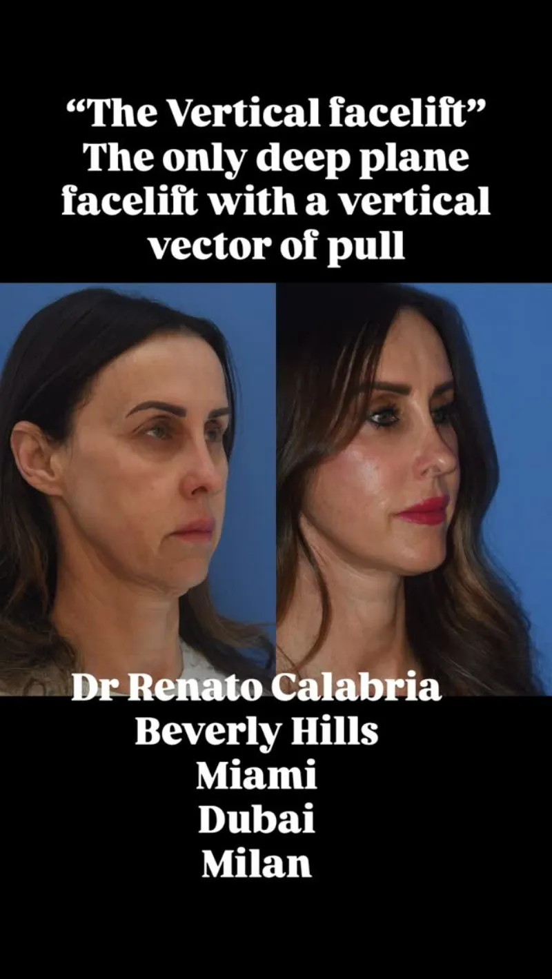 Before and after — Dr. Renato Calabria