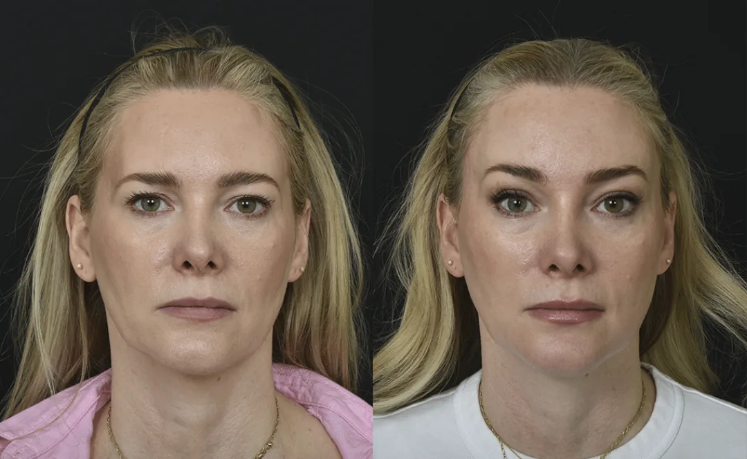 Before and after — Dr. Renato Saltz