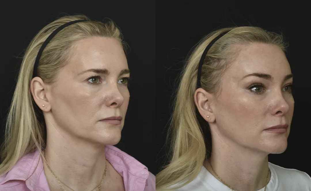 Before and after — Dr. Renato Saltz