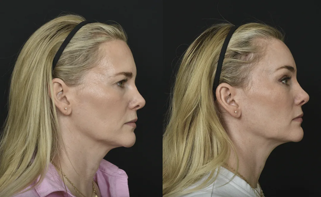 Before and after — Dr. Renato Saltz