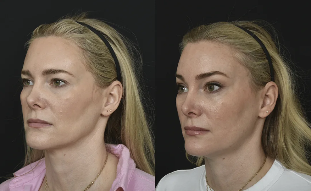 Before and after — Dr. Renato Saltz