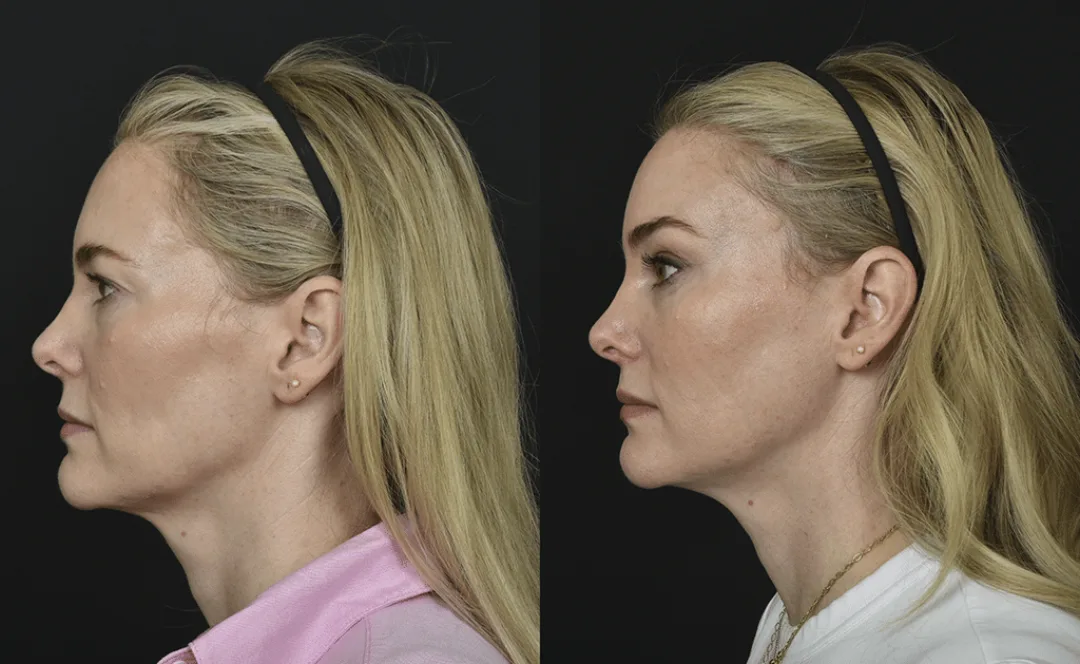 Before and after — Dr. Renato Saltz
