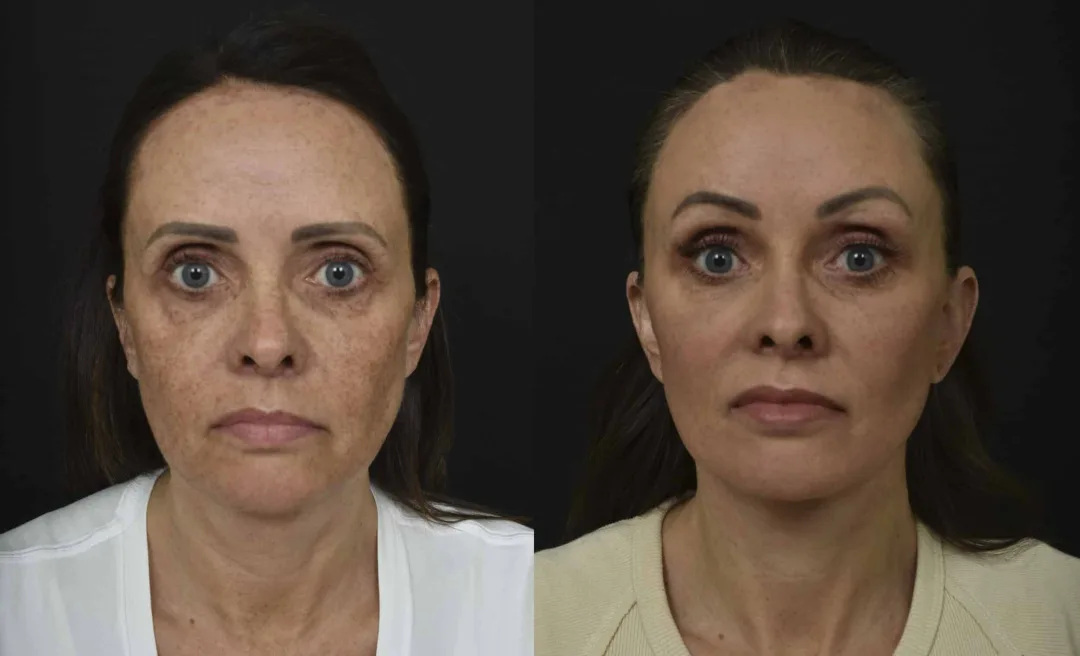 Before and after — Dr. Renato Saltz