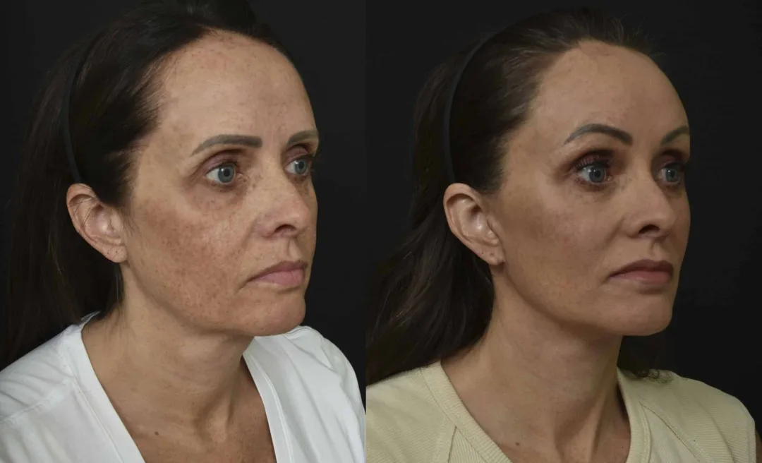 Before and after — Dr. Renato Saltz