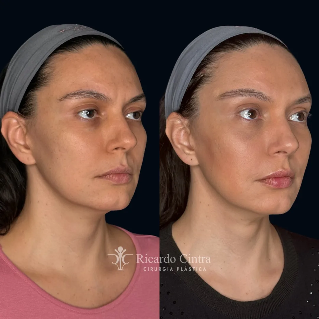 Before and after deep plane facelift — 32-year-old woman, oblique right view, 6mo post-op by Dr. Ricardo Cintra
