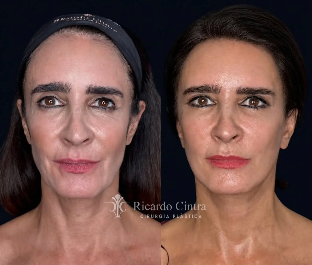 Before and after deep plane facelift — 55-year-old woman, frontal view, 7mo post-op by Dr. Ricardo Cintra