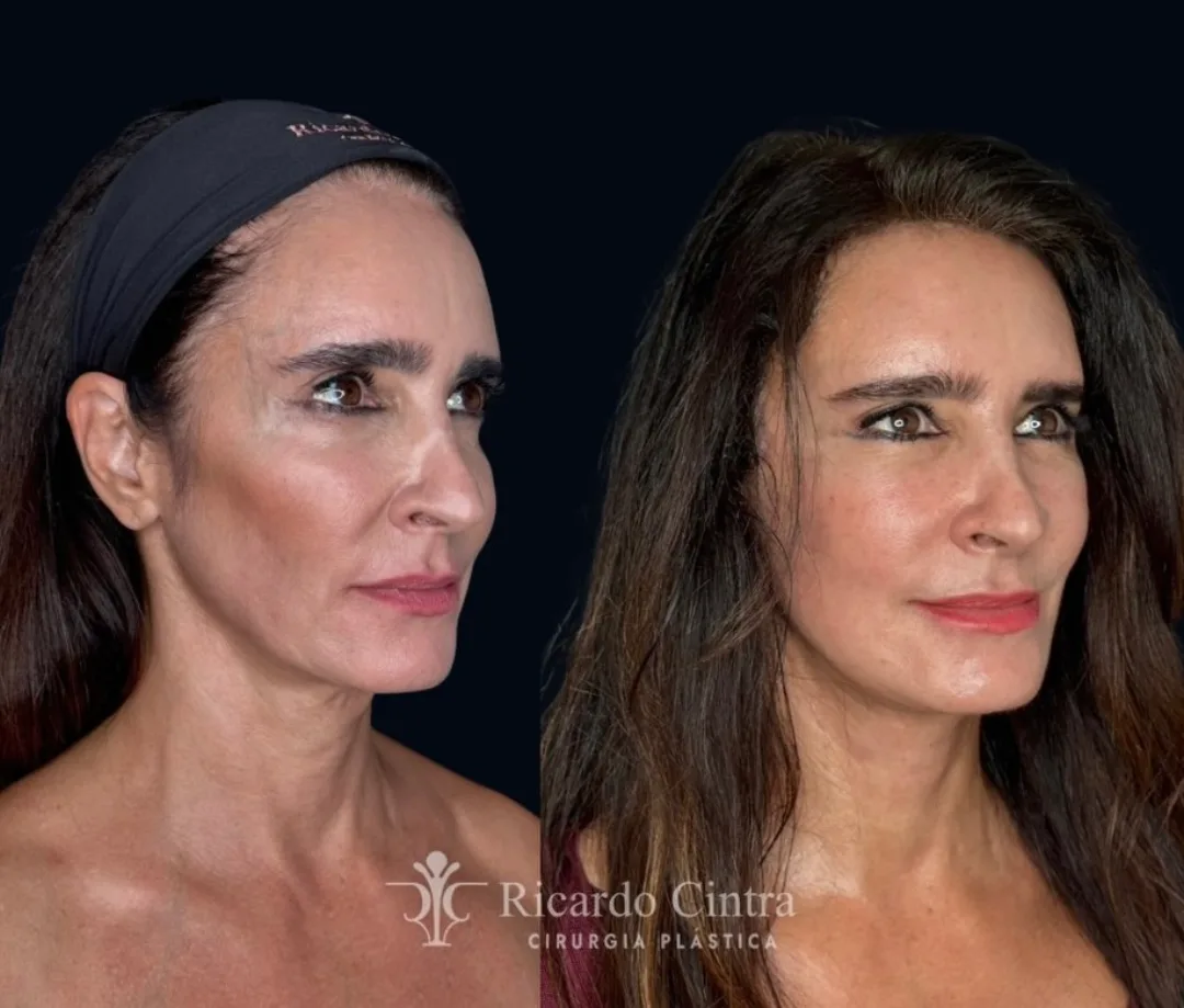Before and after deep plane facelift — 48-year-old woman, oblique left view, 6mo post-op by Dr. Ricardo Cintra