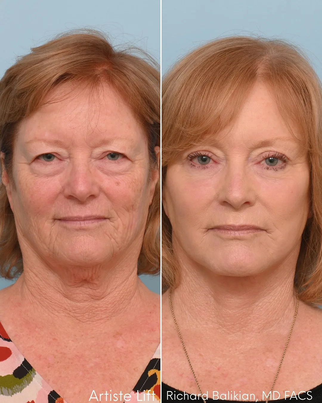 Before and after deep plane facelift — 65-year-old woman, frontal view, 7mo post-op by Dr. Richard Balikian