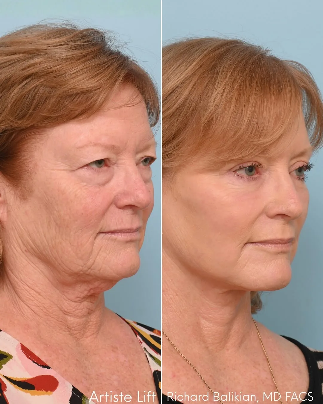 Before and after deep plane facelift — 62-year-old woman, oblique right view, 7mo post-op by Dr. Richard Balikian