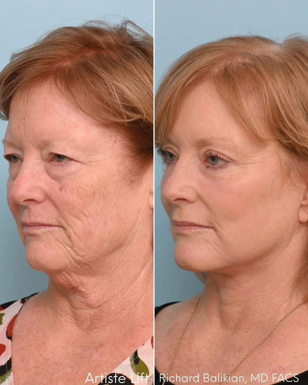 Before and after deep plane facelift — 58-year-old woman, right profile view, 6mo post-op by Dr. Richard Balikian