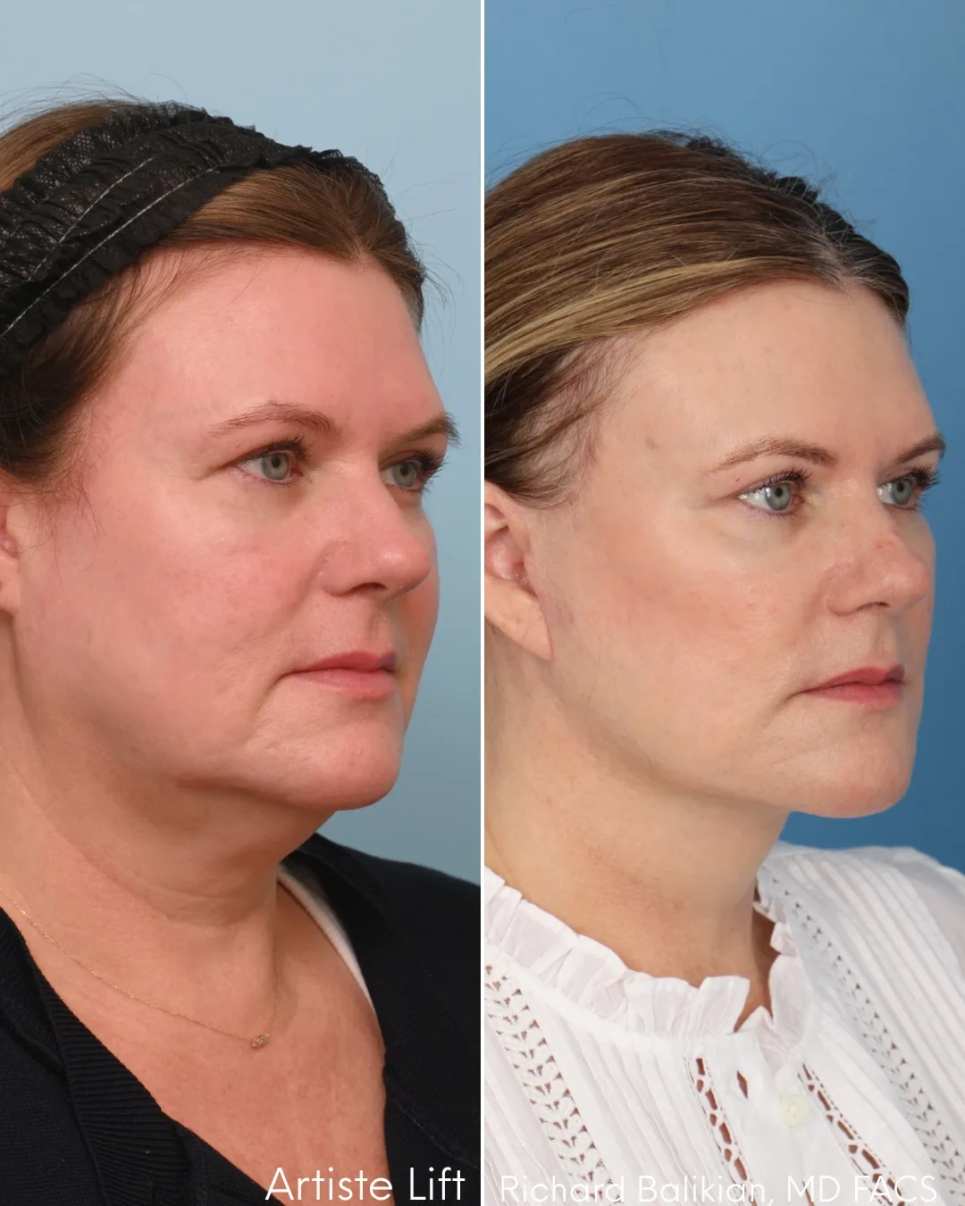 Before and after deep plane facelift — 52-year-old woman, left profile view, 6mo post-op by Dr. Richard Balikian