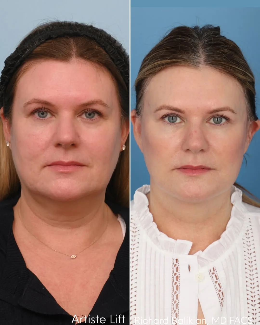 Before and after deep plane facelift — 48-year-old woman, frontal view, 7mo post-op by Dr. Richard Balikian