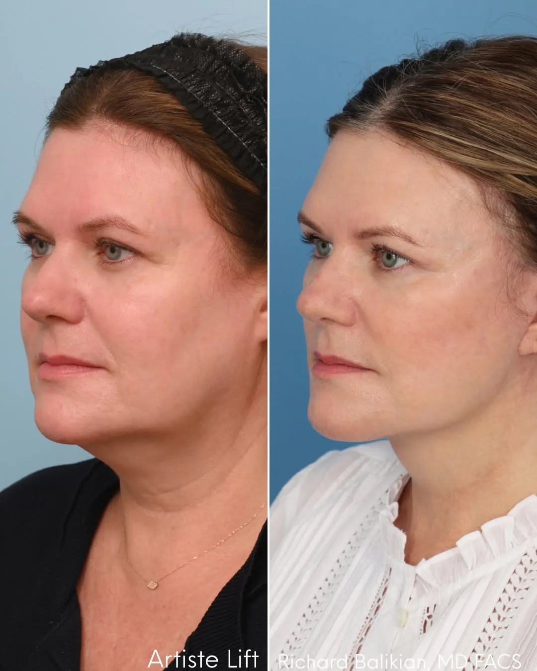 Before and after deep plane facelift — 52-year-old woman, right profile view, 6mo post-op by Dr. Richard Balikian
