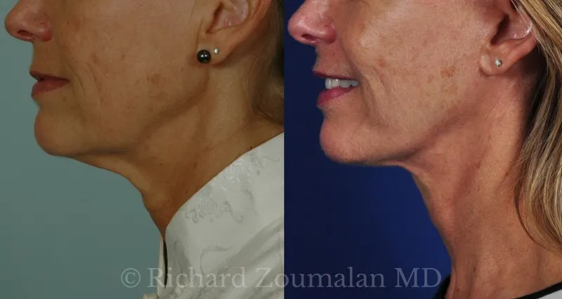 Before and after deep plane facelift — 55-year-old woman, right profile view, 6mo post-op by Dr. Richard Zoumalan