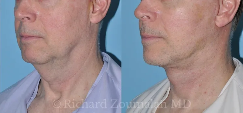 Before and after deep plane facelift — 55-year-old man, right profile view, 6mo post-op by Dr. Richard Zoumalan