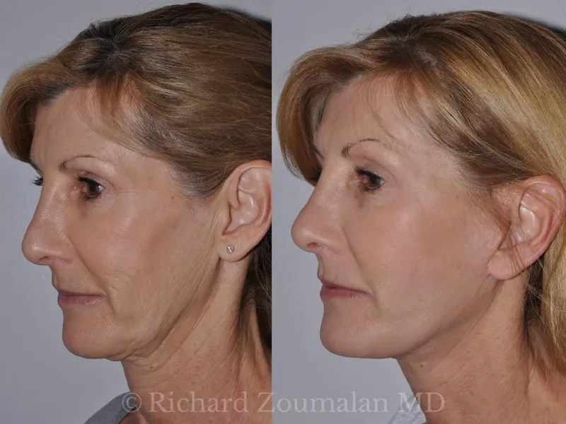 Before and after deep plane facelift — 55-year-old woman, right profile view, 6mo post-op by Dr. Richard Zoumalan
