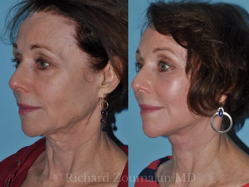 Before and after deep plane facelift — 55-year-old woman, right profile view, 6mo post-op by Dr. Richard Zoumalan