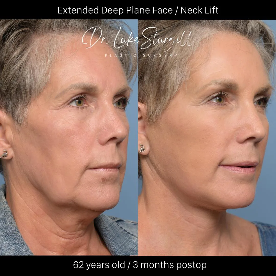 Before and after deep plane facelift — 62-year-old woman, three-quarter view, 3mo post-op by Dr. Riley Sturgill