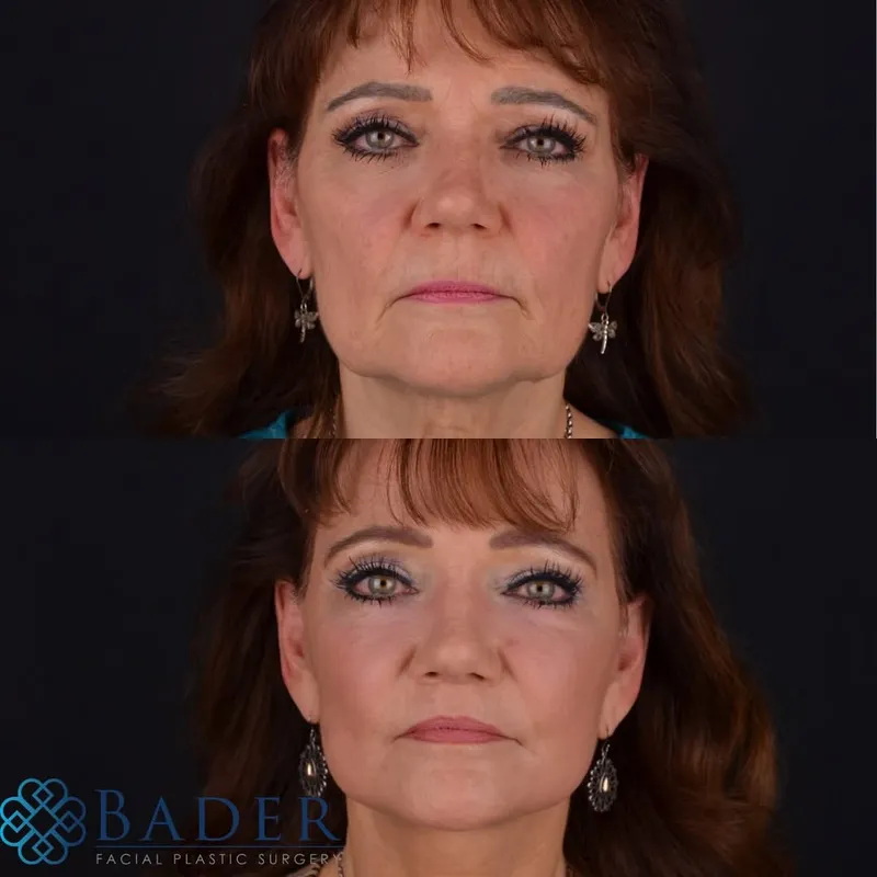 Before and after — Dr. Robert Bader