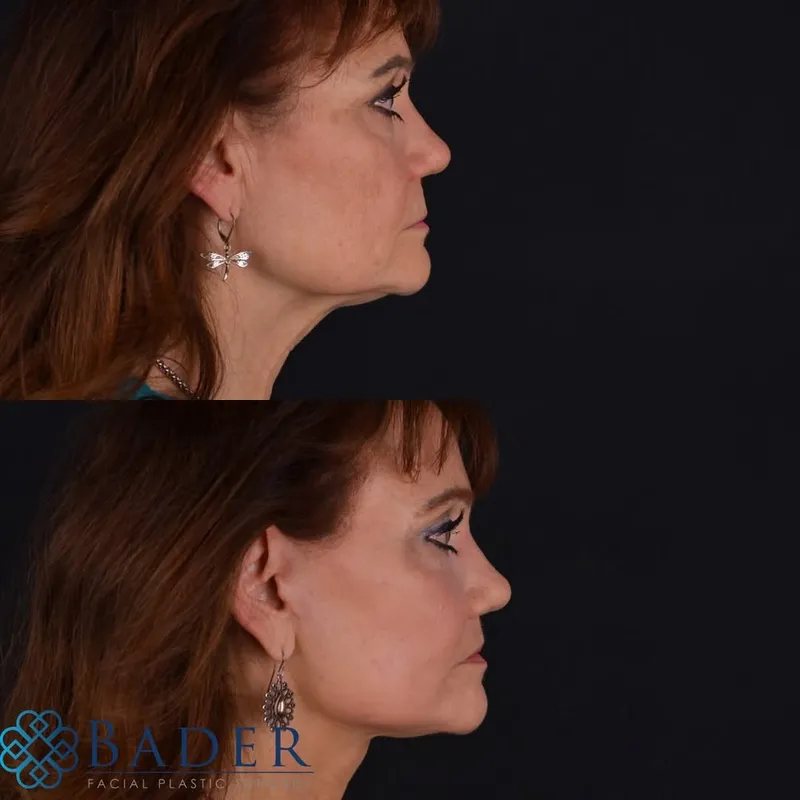 Before and after — Dr. Robert Bader