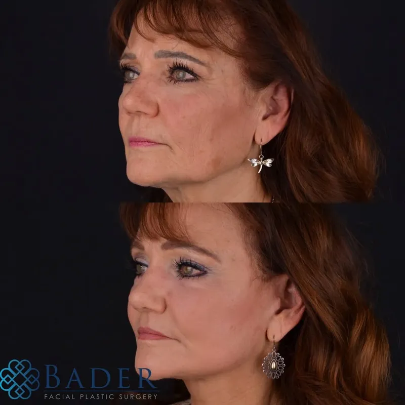 Before and after — Dr. Robert Bader