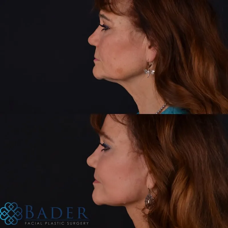 Before and after — Dr. Robert Bader