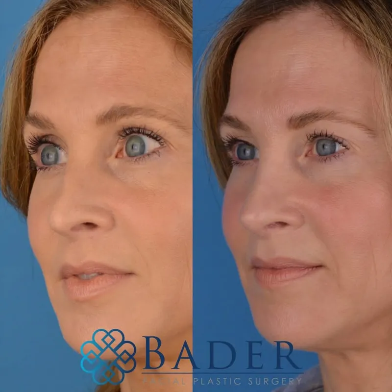 Before and after — Dr. Robert Bader