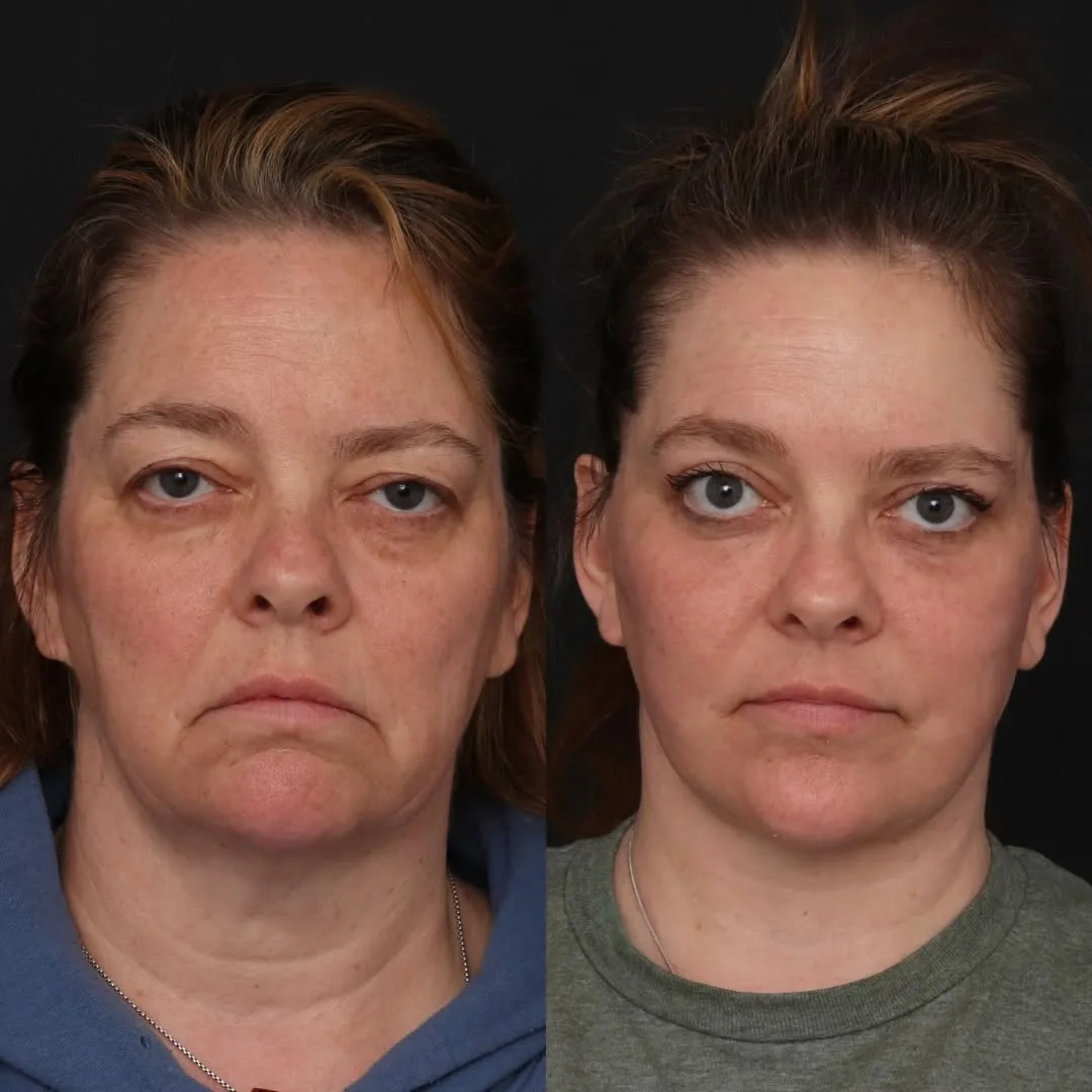 Before and after — Dr. Robert Glasgold