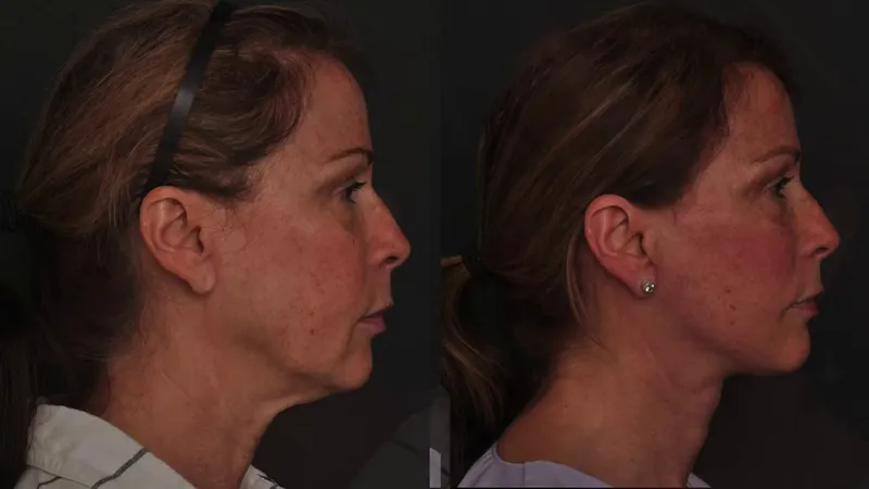 Before and after — Dr. Robert Glasgold