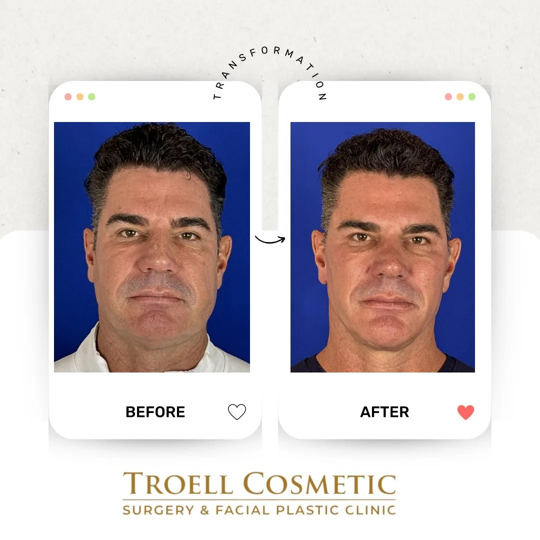 Before and after — Dr. Robert Troell