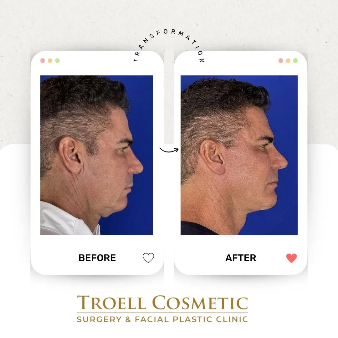 Before and after — Dr. Robert Troell