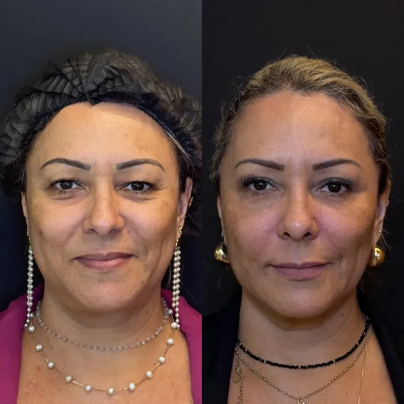 Before and after deep plane facelift, frontal view by Dr. Robson Radmacker
