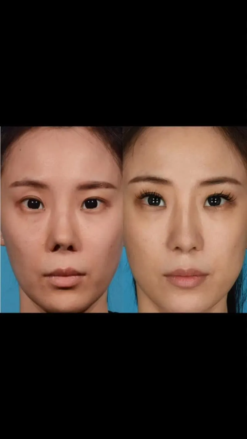 Before and after — Dr. Rod Rohrich
