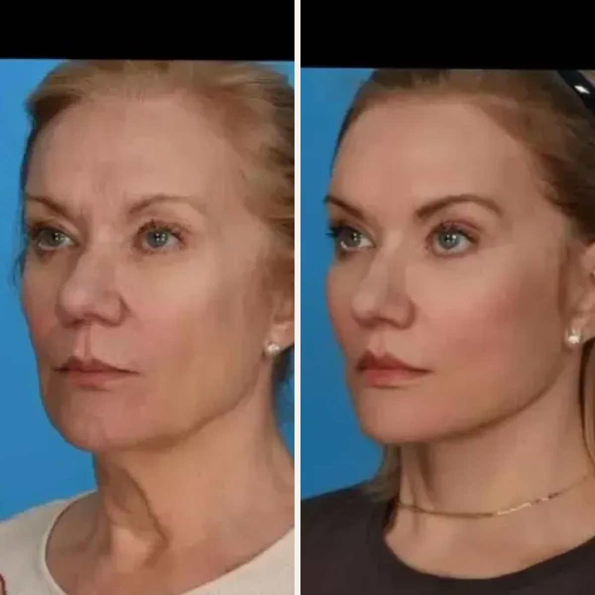 Before and after: Dr. Rod Rohrich