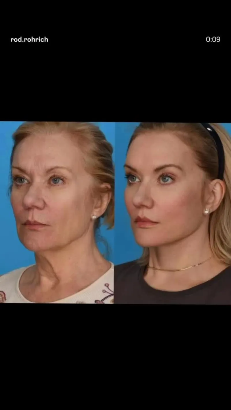 Before and after — Dr. Rod Rohrich