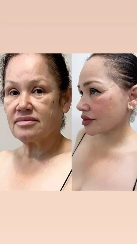 Before and after deep plane facelift, frontal view by Dr. Roy Soltero